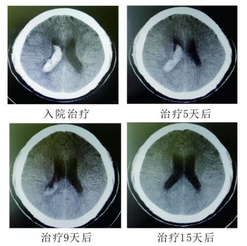 腦出血你不得不引起重視的疾?。。?！