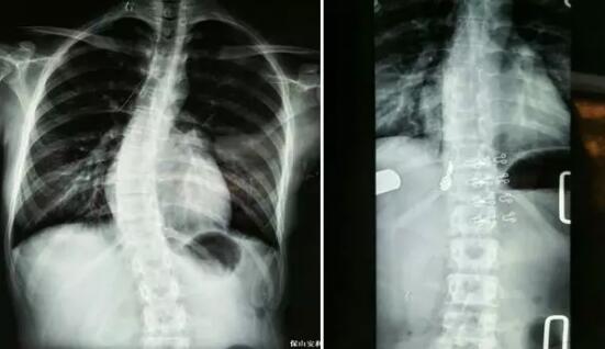好好的脊柱怎么說彎就彎了？你竟然都沒發(fā)現(xiàn)……