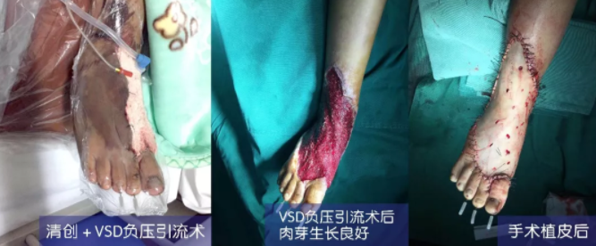 車禍猛如虎，救治如“華佗” ，手術(shù)＋康復(fù)，8歲小女孩車禍后日漸康復(fù)行走