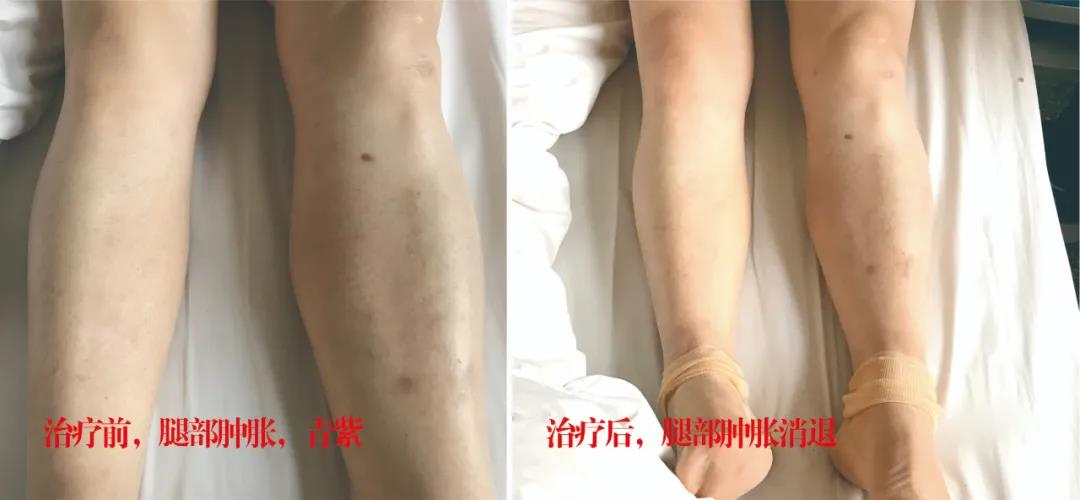 下肢靜脈血栓多年頑疾反復(fù)腫痛——疾病不容等待，早治療，早健康！