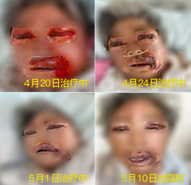 膿毒血癥（急性頜面部蜂窩組織炎）多學科聯(lián)合會診，幫助患者成功治愈！