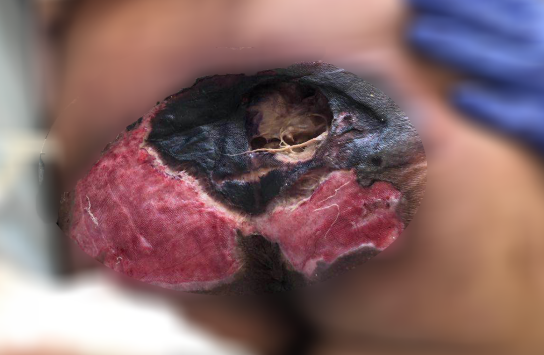 癱瘓3年的女患者臀部居然變成這樣?！