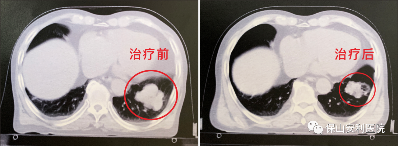 不做手術，早期肺癌也能根治！