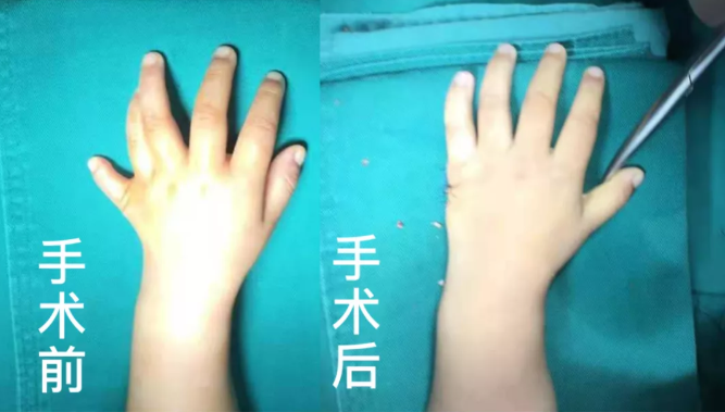 【保山安利醫(yī)院】2歲小兒手、足多指（趾）成功修復(fù)(矯正）！