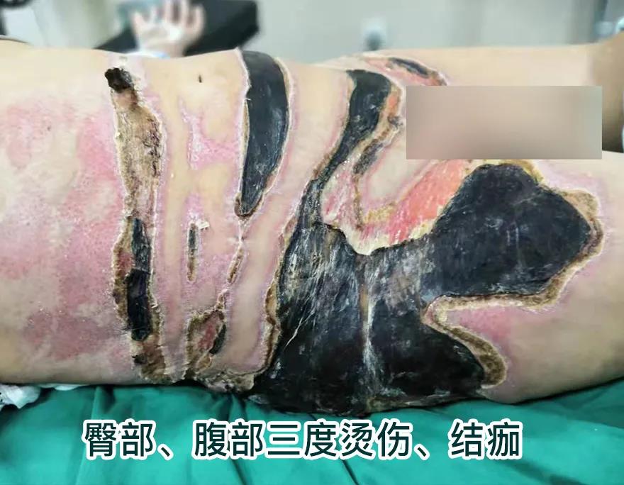 【保山安利醫(yī)院】80歲老人不慎燒傷，導(dǎo)致腹部、右側(cè)臀部大面積創(chuàng)傷，經(jīng)植皮治療創(chuàng)面逐漸愈合