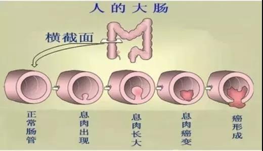 體檢發(fā)現(xiàn)腸息肉會(huì)癌變嗎？