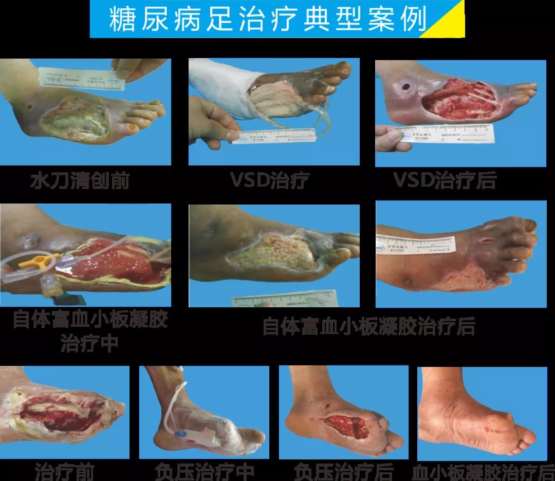 截肢、失明，甚至……，我們要做的是將糖尿病并發(fā)癥遏制在搖籃里！