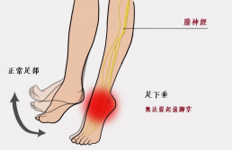 【保山安利醫(yī)院—健康科普】什么是足下垂！你了解嗎？