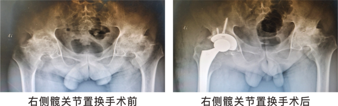 【保山安利醫(yī)院】長(zhǎng)期飲酒導(dǎo)致雙側(cè)股骨頭壞死，髖關(guān)節(jié)置換后重獲運(yùn)動(dòng)功能！