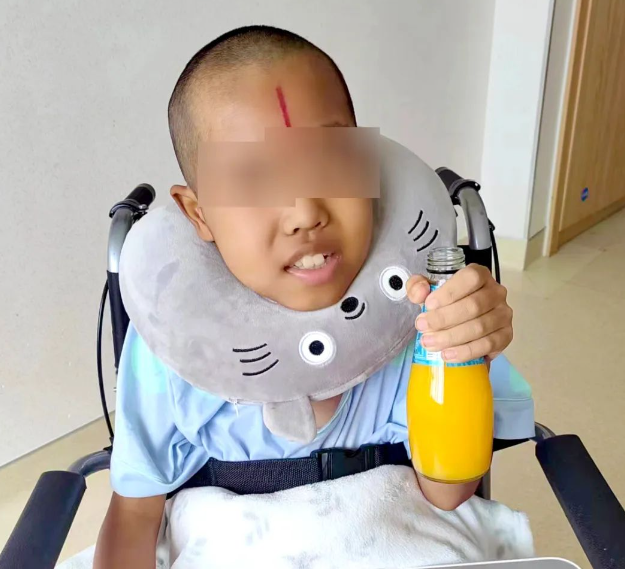 10歲腦干膠質(zhì)瘤患兒經(jīng)23次放療后病情明顯好轉